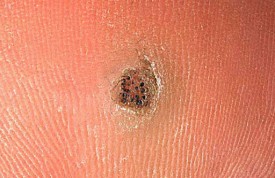 Herpetic Whitlow - Pictures, Treatment, Symptoms, Signs ...
