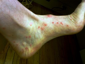Flea Bites On A Human Foot