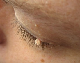 A filiform wart on the upper eyelid