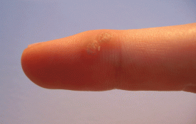 Common Wart on Index Finger