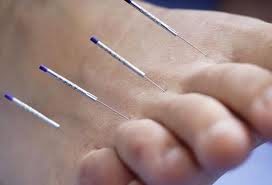 Acupuncture Needles Inserted In A Foot