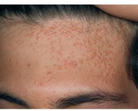 Flat Warts on the Face and Forehead