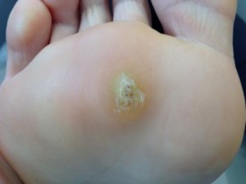 Plantar warts and all other warts are caused by the HPV virus.