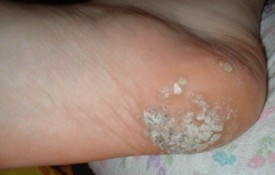 Verruca Wart Mosaic on the Heel of the Foot