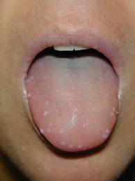 Warts On Tongue