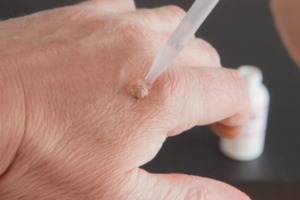 Think twice before you inject salicylic acid into your wart