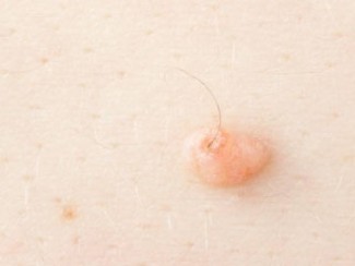 Wart with a hair growing out